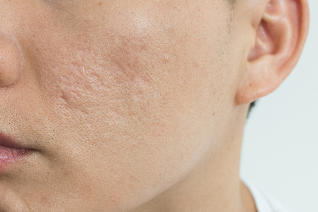 rejuran healer acne scars skin texture