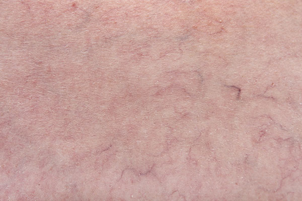 vascular lesions are usually caused by visible veins and blood vessels