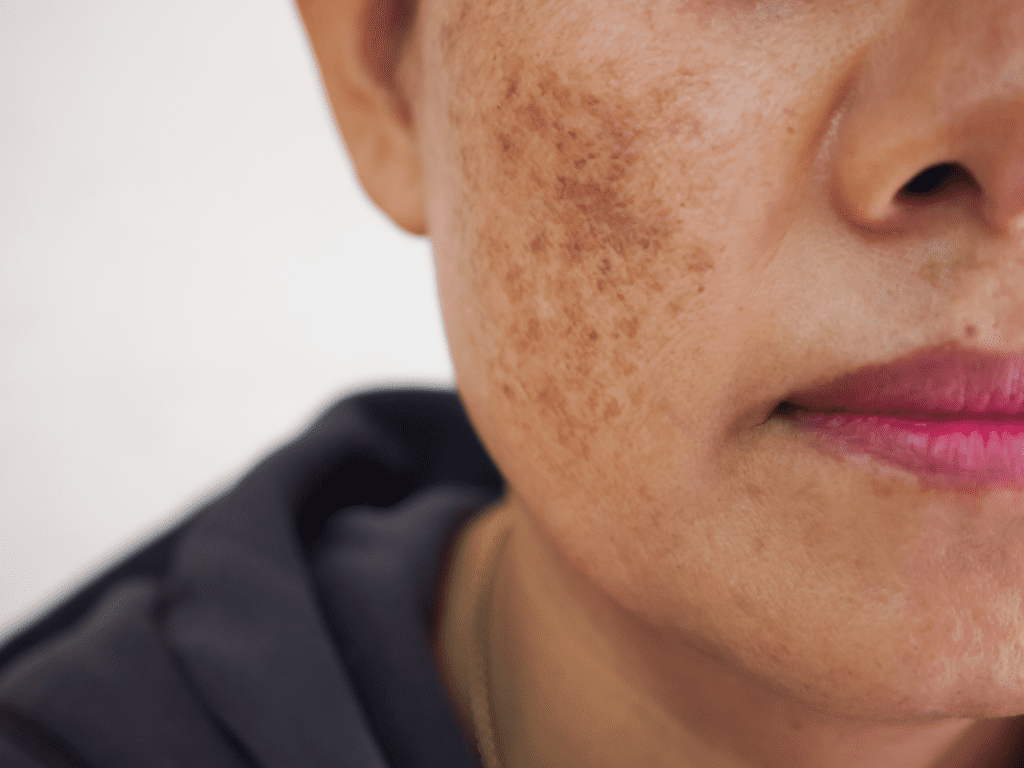 laser treatments in singapore remove post inflammatory hyperpigmentation
